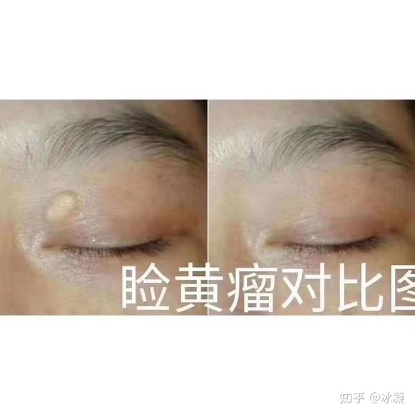 我自己也曾经因为这个睑黄瘤的问题而困扰愁眉不展,因此作为