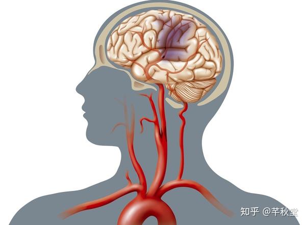 为什么高血压患者容易发生脑血管意外