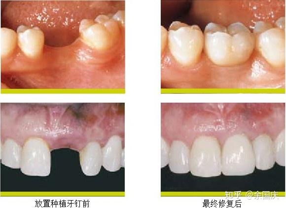 牙龈炎或牙龈增生(这是种植牙危害中发生频率较高的一种)