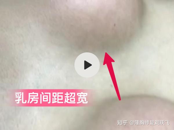 不想假体隆胸术后包膜挛缩,乳房变硬变形,做好这件事就够了