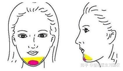 两侧或臀部的脂肪,经过离心机筛选后,以纯净脂肪组织移植到下巴部位