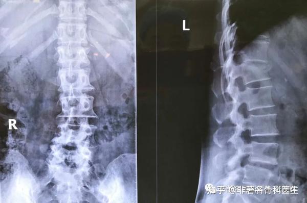 腰椎正侧位x光片:可见腰1椎体压缩性骨折 上终板塌陷,椎体前缘骨折块