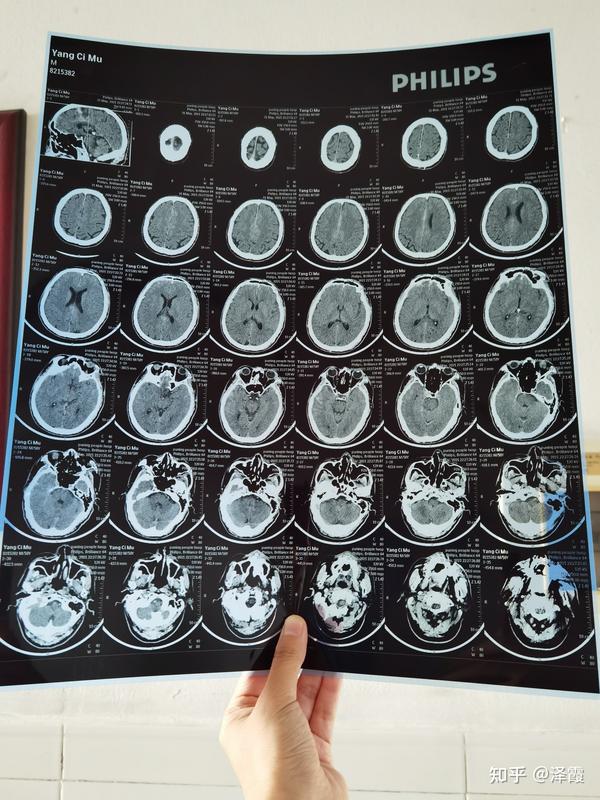我爸爸的脑ct,已经拍了三次了,这两天一直痛的睡不着,在考虑要不要