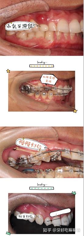 牙齿牵引会造成牙齿松动吗?