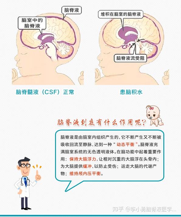 什么是脑积水?能治愈吗?该怎么治?良心科普