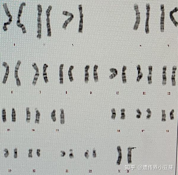 常见,与turner综合征相关的x染色体结构异常主要包括x长臂等臂和缺失