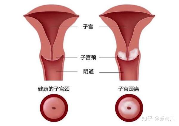 精子要想和卵子在输卵管相遇,就必须挤破头钻过宫颈管;而平时宫颈管