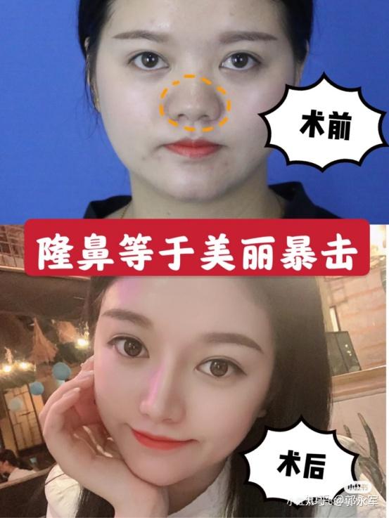 这是她刚做完鼻子的即刻对比,可以很明显的看出鼻尖的改变.