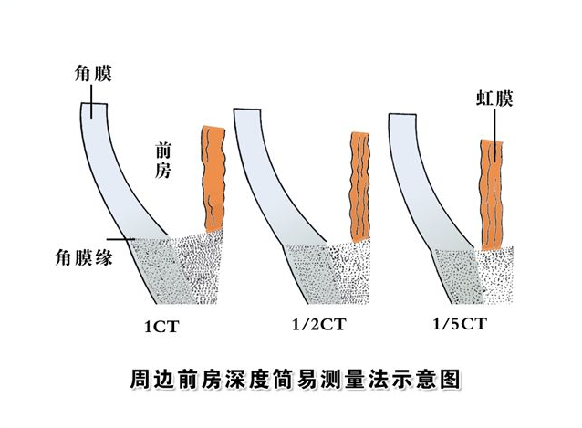 手术,晶体植入手术是一种眼内手术,它需要把人工晶体植入眼内(眼后房