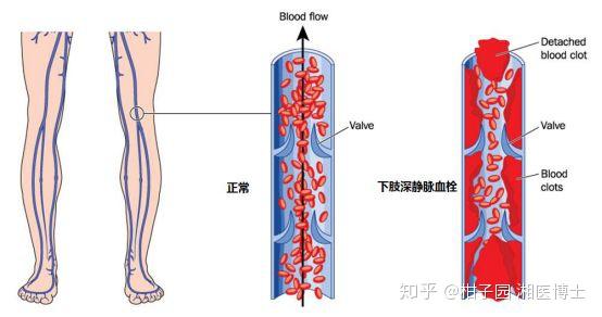 下肢深静脉血栓形成,下肢深静脉瓣膜功能不全,下肢静脉曲张,布加氏
