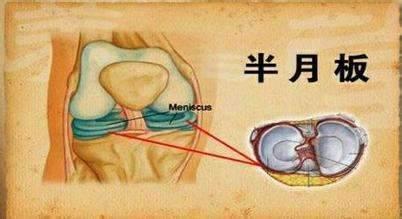 半月板移植是什么——健康科普