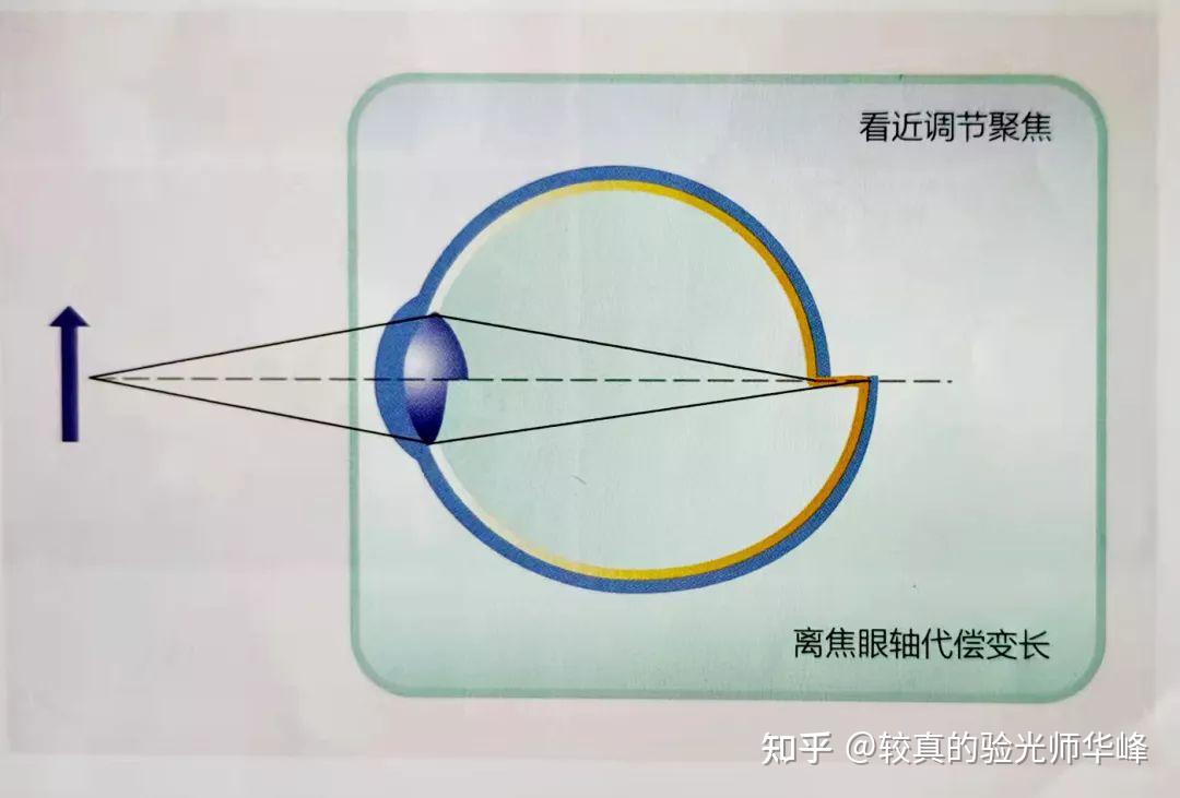 什么是眼睛的调节力和近视有啥关系通俗版一看就懂得回答