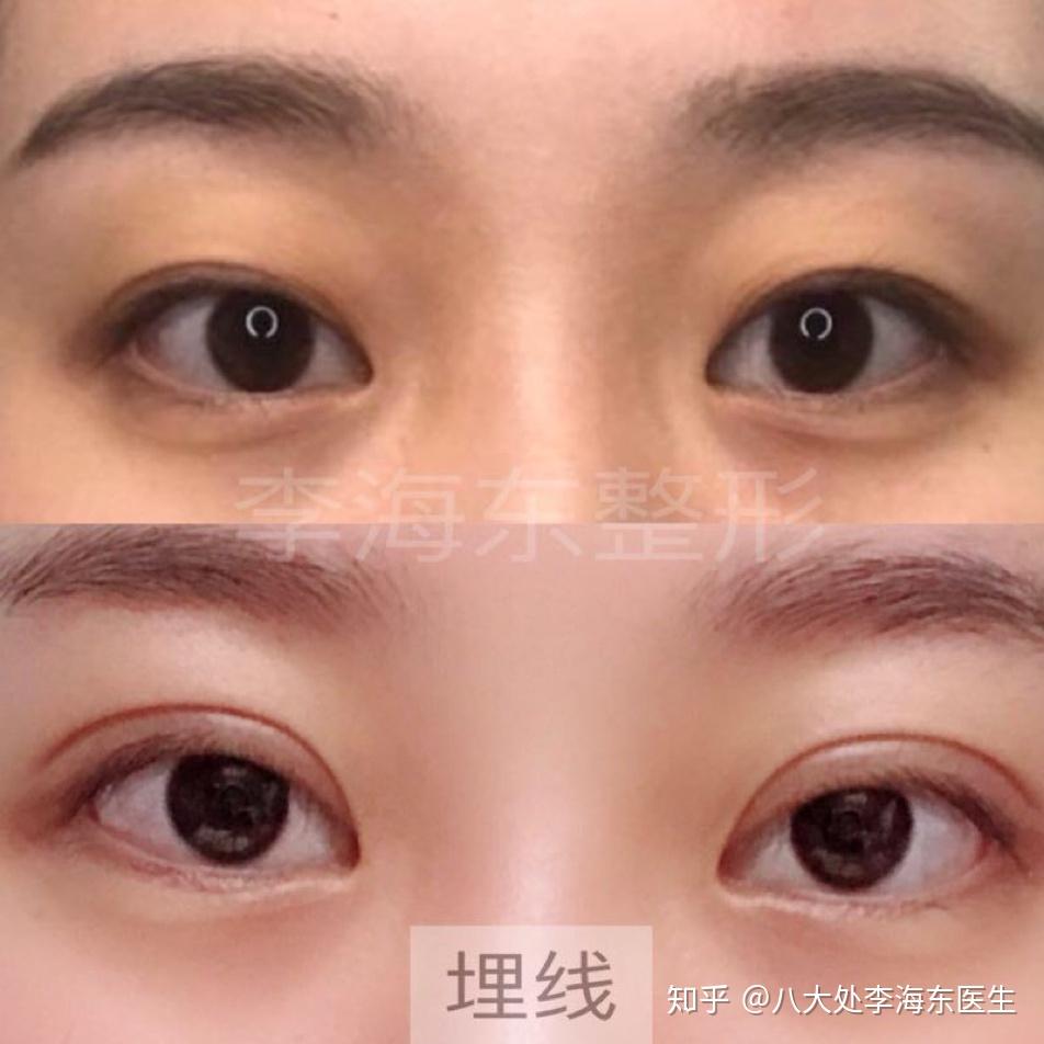 埋线三点定位和全切双眼皮的区别