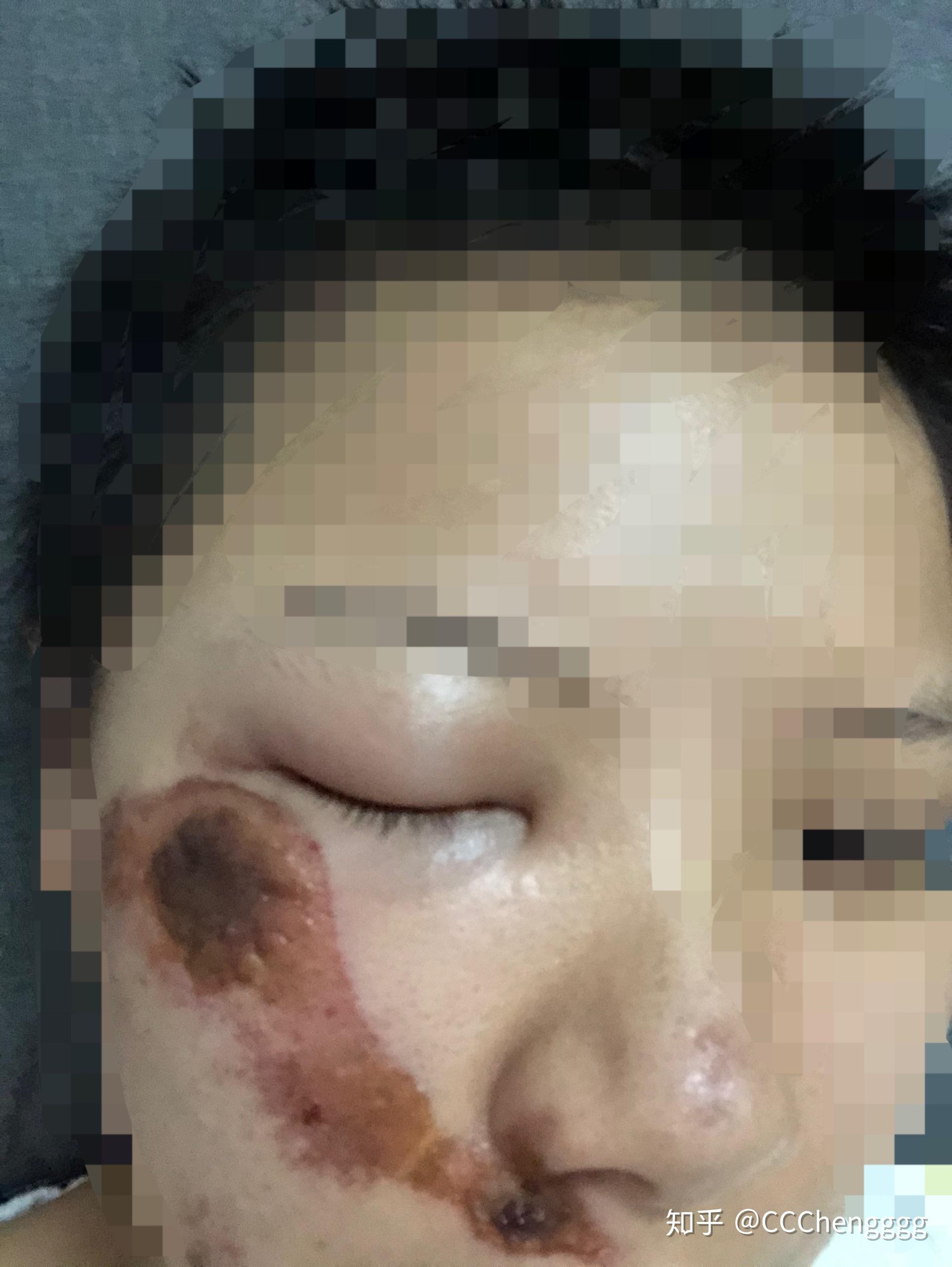 不过结痂的快,掉的也快,都是表皮擦伤没有伤及真皮层,所以恢复得很快.