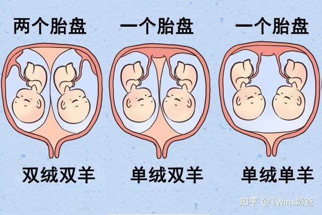 怎么判断自己怀的双胞胎是一个胎盘还是两个是双绒双羊还是单绒双羊