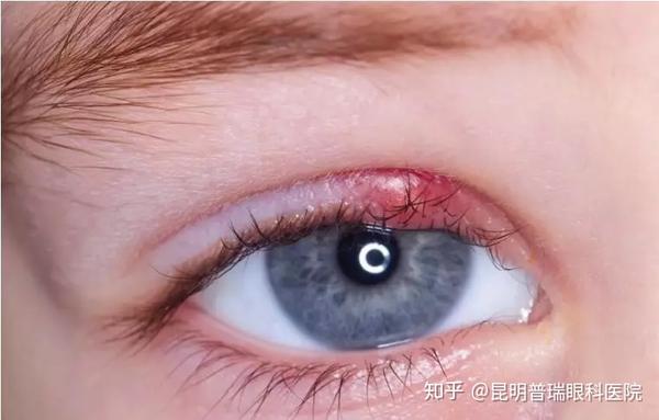 麦粒肿多发于多发于儿童,家长可得看看