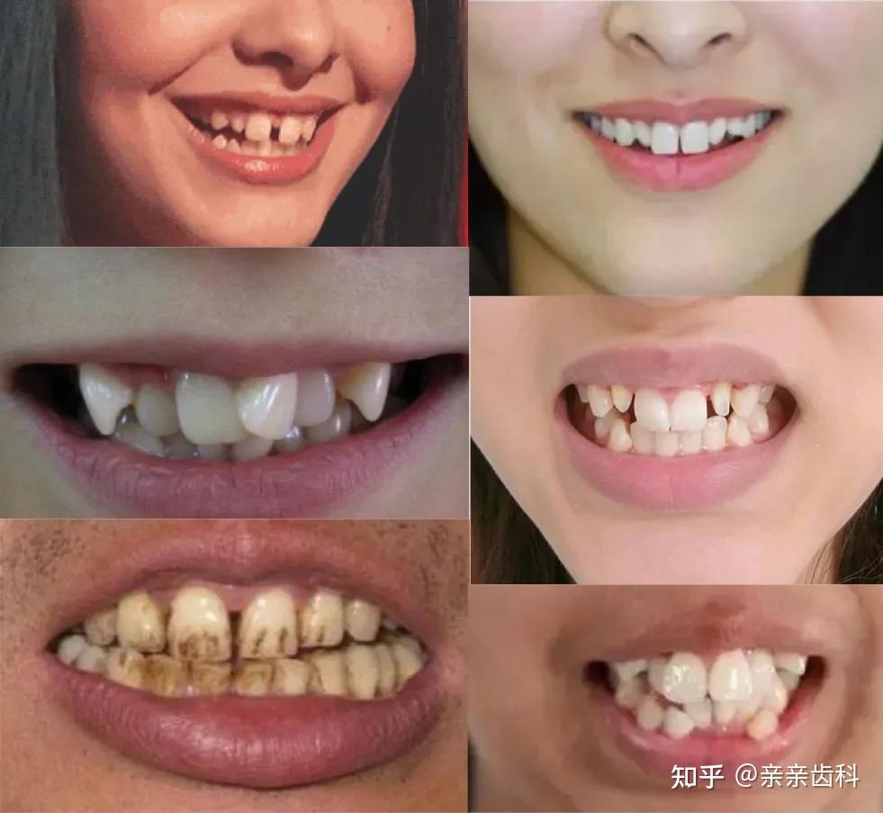 比如:牙齿不整齐,缺牙,牙缝大,过小牙,瓜子牙,牙釉质发育不全,氟斑牙