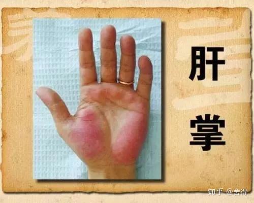 大拇指和小指根部的大小鱼际处出现片状出血的现象,就是所谓的"肝掌"