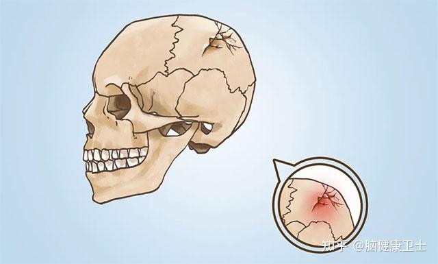 颅脑损伤是一种常见外伤,可单独存在,也可与其他损伤复合存在.