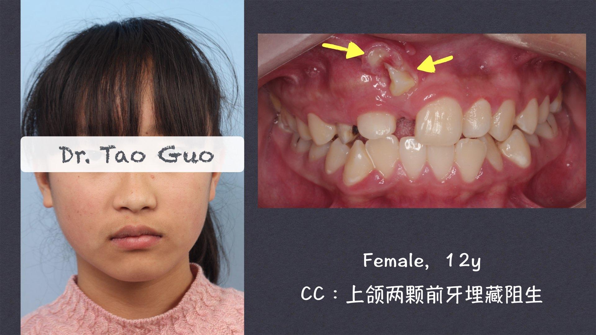 青少年牙齿埋藏阻生矫正案例