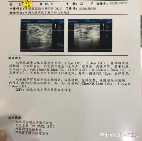 不要再被钙化绑架乳腺结节患者经历