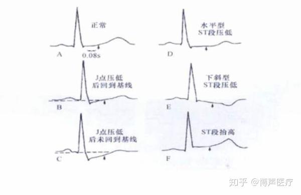 博声医疗:st段改变,st段改变是什么意思?