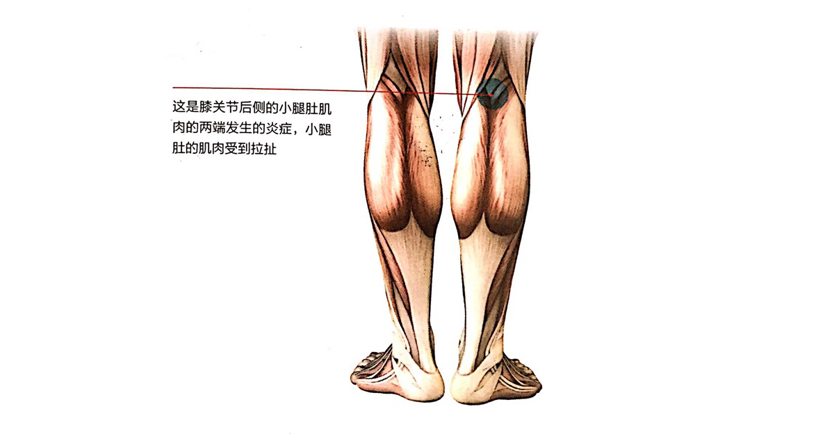 腓肠肌疼痛主要发生于膝关节后侧,而且主要发生在右腿.