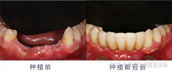 种植牙的牙冠可以搭桥吗?