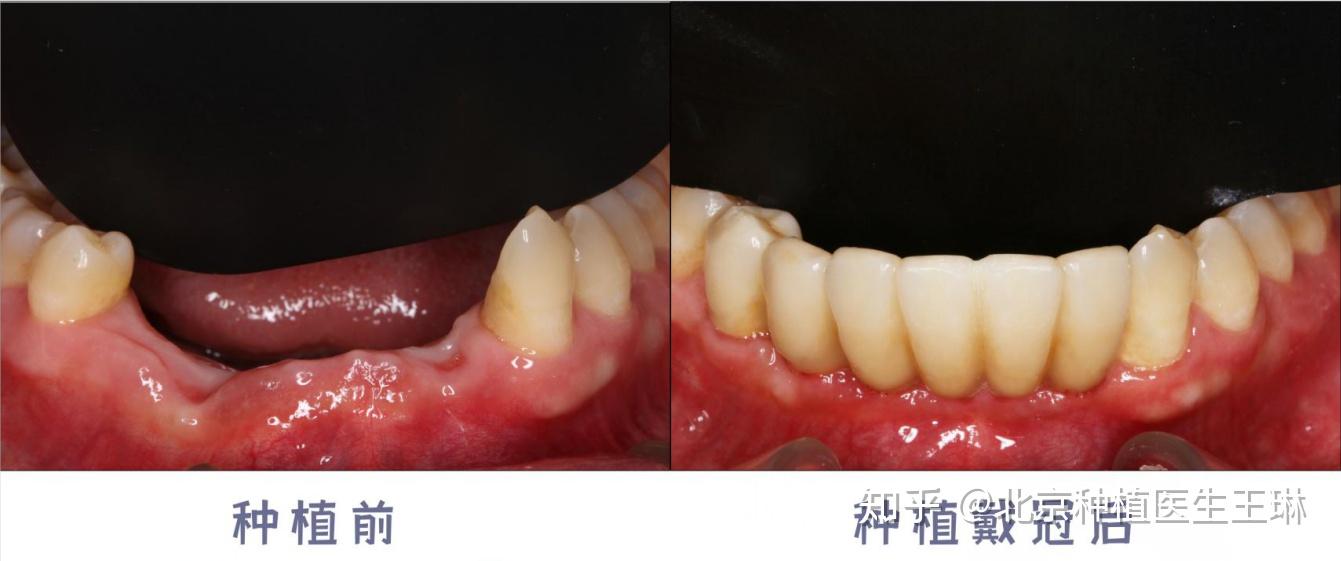 种植牙的牙冠可以搭桥吗