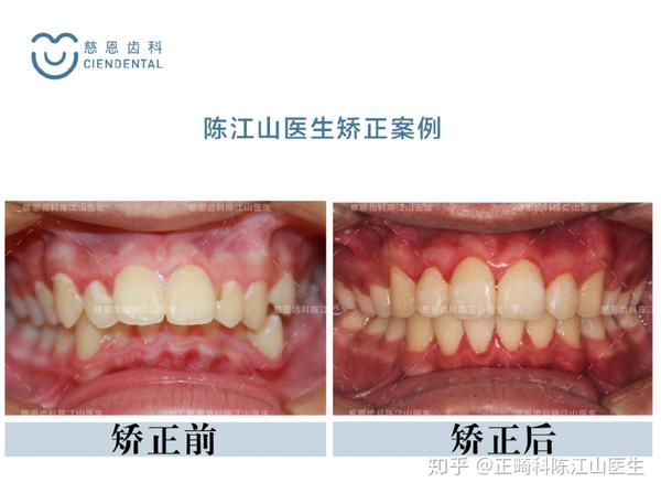 矫正结束后,我们能清楚地看到他的牙齿中线已对齐,深覆合覆盖已解决