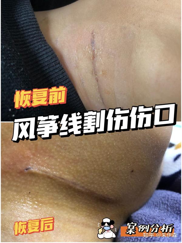 风筝线割伤伤口手术后粘合伤