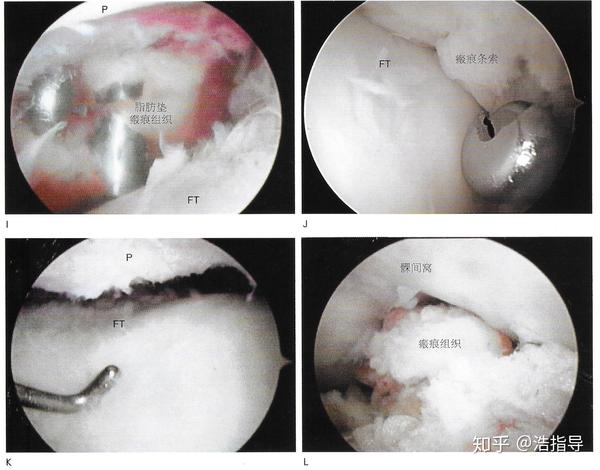 关节镜通过外上入口观察显示脂肪垫并且使用工具切除髌下瘢痕组织.