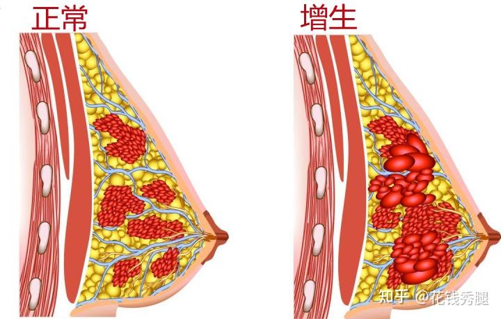 乳腺增生是什么原因