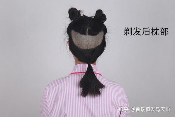 剃发植发,不剃发植发,长发植发如何选