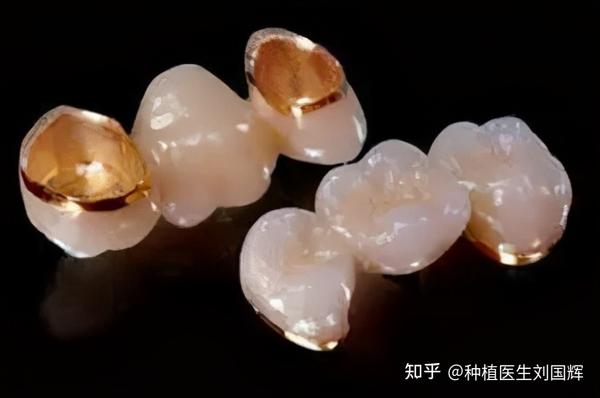 牙套,即由惰性金属和烤瓷制成的,其内冠是常见的一层镍铬合金,钛合金