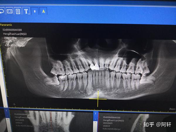 有口腔医生可以帮我看看我拍的ct图吗