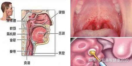耳鼻喉专家提醒扁桃体炎与咽炎如何区分