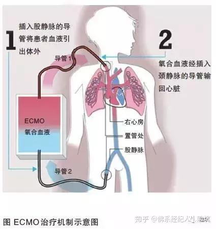 ecmo(体外膜肺氧和)又被称作"人工肺","叶克膜",是一种医疗急救设备.