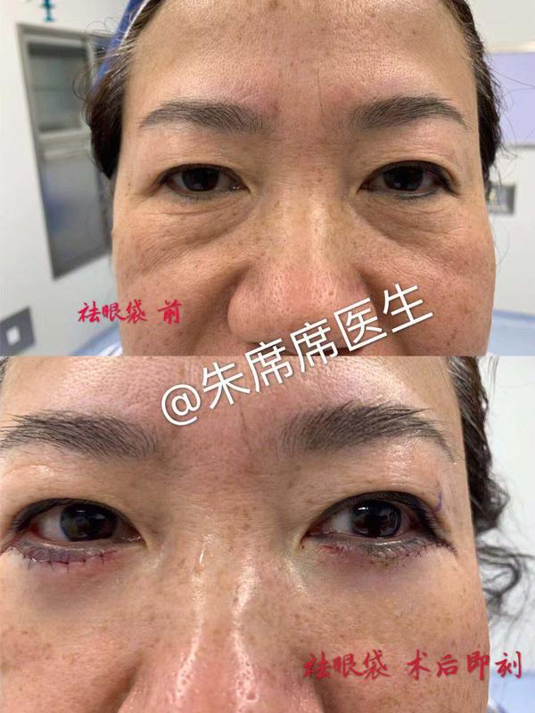 医 ,才不近仙者不可以为医 58岁阿姨祛眼袋, 眼部问题:眼袋重 皮肤松