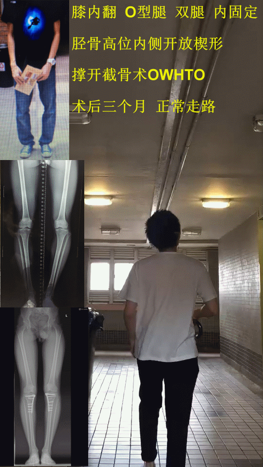 大汇总ox型腿膝内外翻矫正专业科普 膝内翻o型腿-胫骨