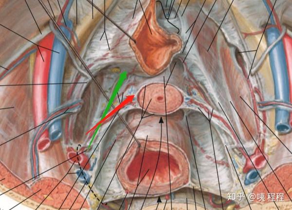 红色:子宫主韧带及子宫动脉;绿色:输尿管