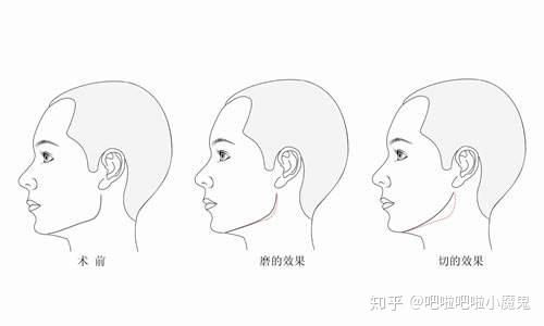 磨骨颏侧截骨国字脸的福音