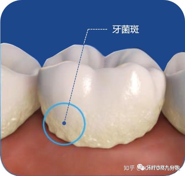 本来覆盖在牙齿表面的"脏东西"叫牙菌斑,正常刷牙可以被清除,但