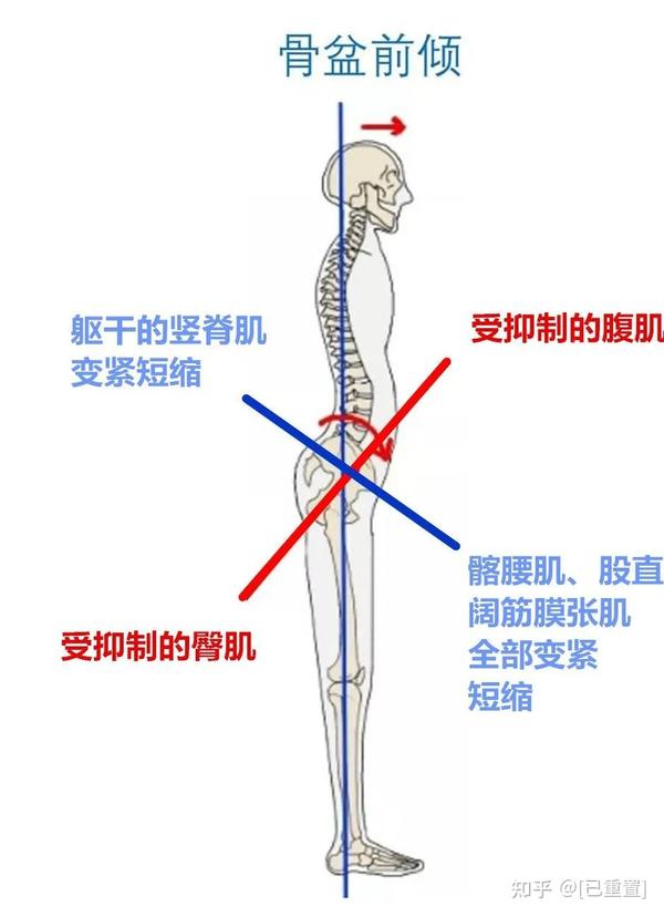 骨盆前倾的四大危害,一个比一个严重!