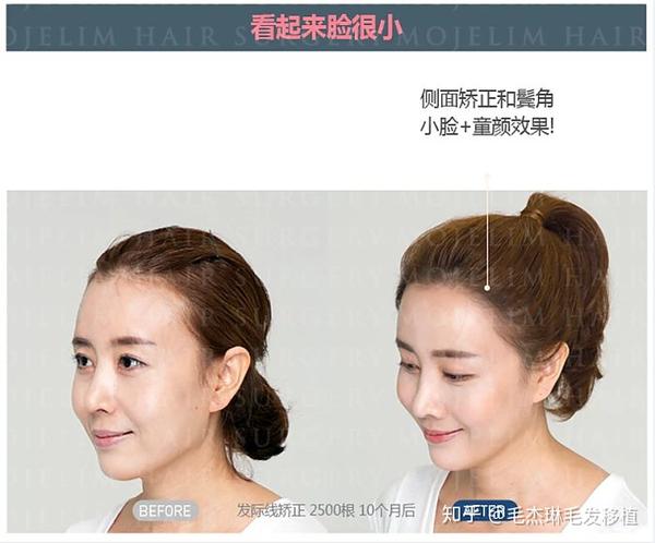 女性发际线矫正侧面矫正很重要