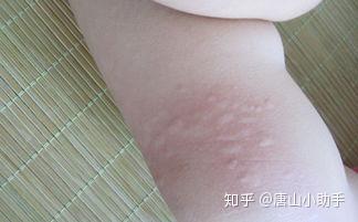 唐山青华医院告诉如何区分湿疹与荨麻疹