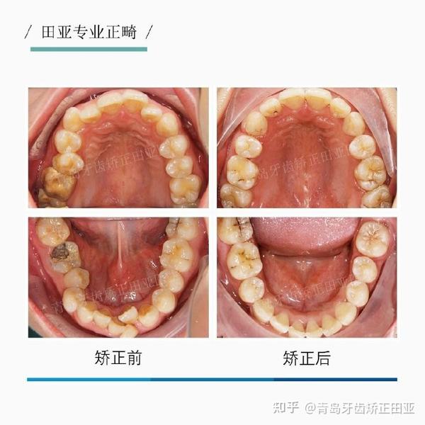 深覆合需要做矫正吗青岛牙齿矫正