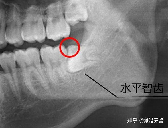 万恶的水平智齿还是早点拔一拔吧