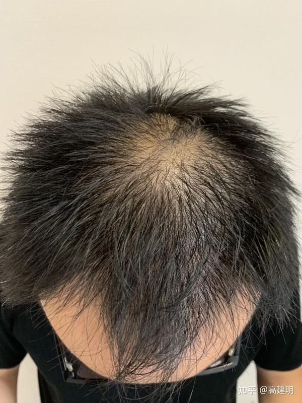 有关雄激素性脱发的10个问题
