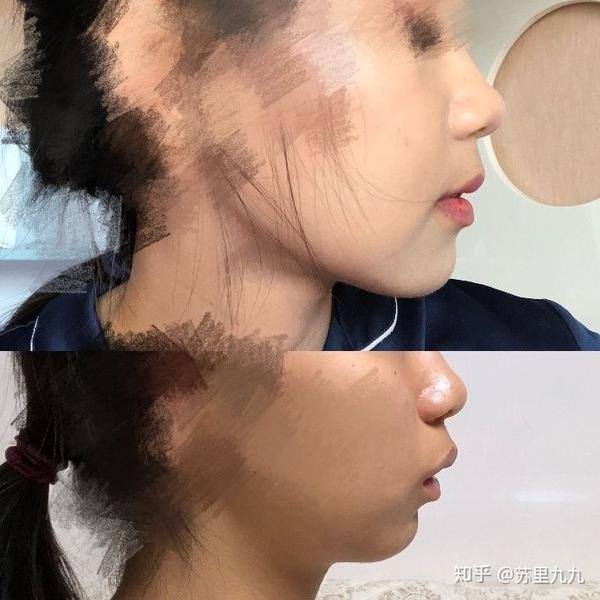 正颌手术需要多少钱?风险大吗?